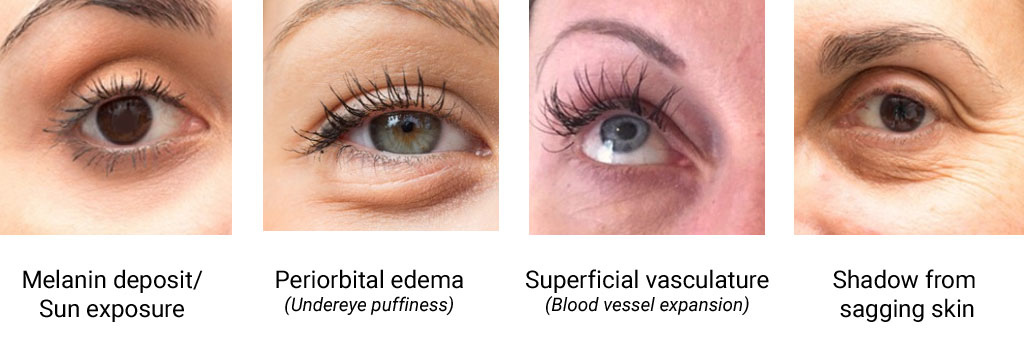 Dark-Eye-circles-2