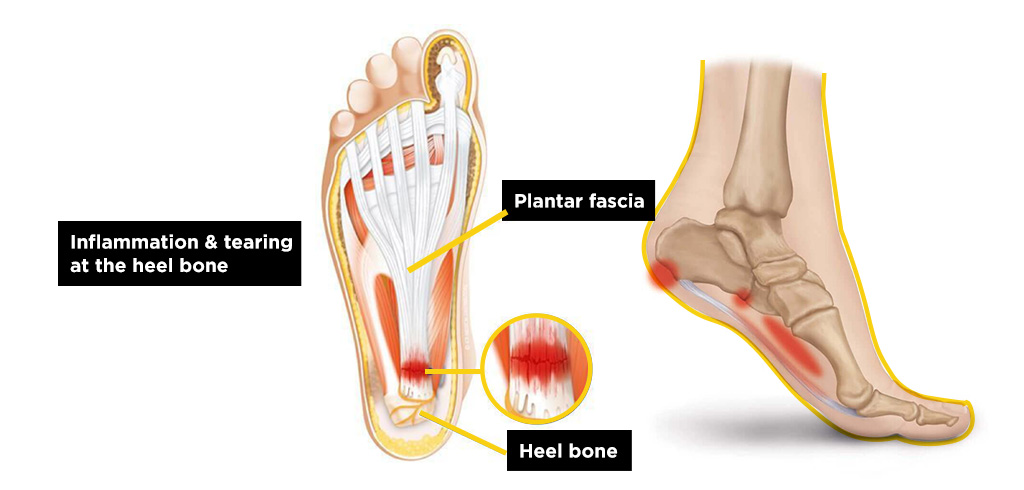 Why Does the Heel Bear the Most Pain?
