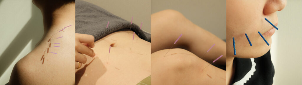 PULSE Seirin Needle Acupuncture