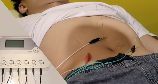 Electroacupuncture