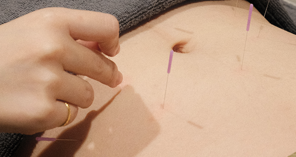 Traditional Acupuncture