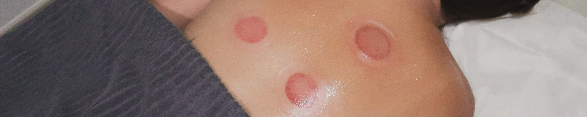 TCM Cupping Marks on a person's back
