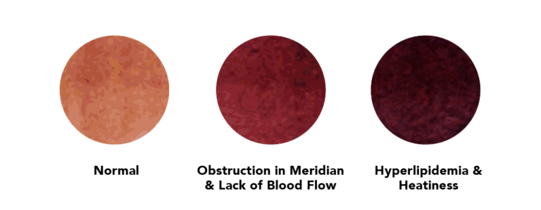 TCM Cupping Mark colors and meaning