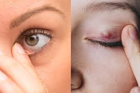 internal and external styes