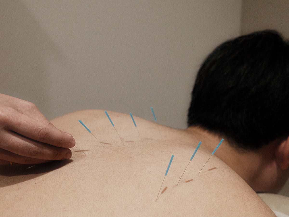 Back-Acupuncture-Service-min